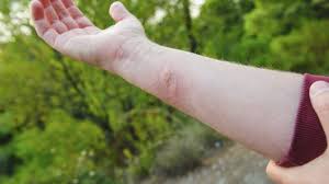 Auch wenn das eher selten vorkommt so behandelst du einen hummelstich. Insektenstiche Was Hat Mich Da Gestochen Und Was Hilft Onmeda De