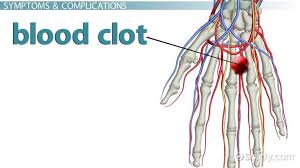 Blood Clot In The Hand Symptoms Signs Treatment