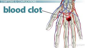 blood clot in the hand symptoms signs treatment