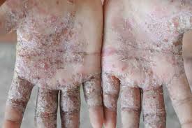 Image result for skin rash similar to scabies