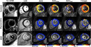 Most of the time, it is caused by an infection that reaches the heart. Different Myocardial Perfusion Status In Acute Myocardial Infarction And Infarct Like Myocarditis A Novel Intravoxel Incoherent Motion Diffusion Weighted Imaging Based Mri Study Academic Radiology