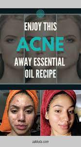 How To Get Rid Of Cystic Acne With 9 Dermatologist Recommended Tips Cysticacnehowtogetridof Cystic Acne Acne Remedies Cystic Acne On Chin
