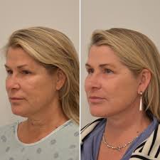 Dr. Learn and Dr. Dudas have successfully helped numerous individuals in  our community regain their confidence by addressing loose, sagging neck  skin through mini face and neck lift procedures in Fort Lauderdale,