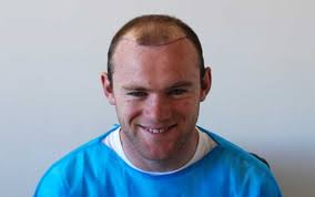 At 11:25 pm 7 comments. Wayne Rooney S Hair Transplant Result Harley Street Hair Clinic