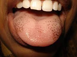 Image result for black tongue symptoms