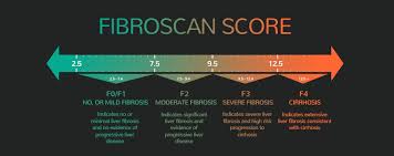Fibroscan Score Liver Disease High Risk