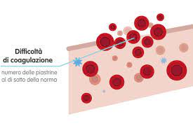 Condizione patologica caratterizzata dalla riduzione del numero delle piastrine circolanti al di sotto di. Piastrinopenia Sapete Che Cos E E Cosa Comporta Supermamma