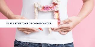 Stage 2a or 2b, commonly with deeper stomach wall involved. How To Spot Early Symptoms Of Colon Cancer Check Causes Of Colon Cancer