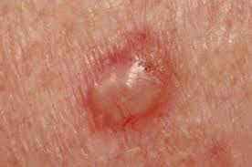 The strongest risk factor for developing skin cancer is ultraviolet (uv) ray exposure, typically from the sun. When Cancer Can Mimic An Earlobe Pimple Know The Signs Scary Symptoms