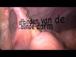 Hiermee wordt voorkomen dat de blindedarmontsteking doorbreekt (perforeert) en. Acute Blinde Darm Ontsteking Laparoscopie Dr Konsten Youtube