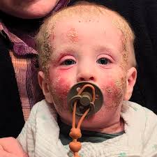 Fundraiser for Rachael Mahan by Christa Conrad : Help Baby Gabriel Heal  from Severe Eczema