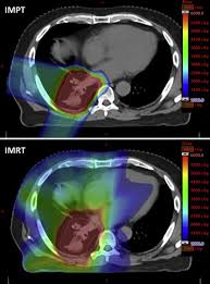 Multifocal lung cancer discussion and case presentation. Early Outcomes Of Patients With Locally Advanced Non Small Cell Lung Cancer Treated With Intensity Modulated Proton Therapy Versus Intensity Modulated Radiation Therapy The Mayo Clinic Experience Advances In Radiation Oncology