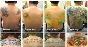 See reviews, photos, directions, phone numbers and more for the best tattoo removal in virginia beach, va. Laser Tattoo Removal