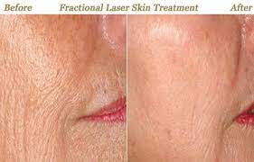 Maybe you would like to learn more about one of these? Fractional Laser Resurfacing Treatments Minneapolis