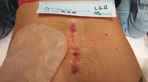 Heridas y Cicatrización