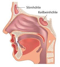 Chronische Sinusitis Ursachen Symptome Therapie