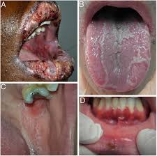 Image result for Erythema Multiforme Major