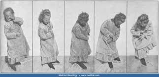 Image result for Chorea