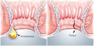 Oftmals stecken analrisse, divertikel im darm. Blutiger Stuhl Ursachen Behandlung Vorbeugung Gesundpedia De