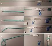 Image result for icd 10 code for suprapubic catheter replacement