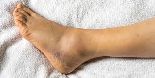 Jul 24, 2019 · ace fitness recommends a seated heel raise during which you lay a plate or heavy dumbbell on your thighs while seated on a weight bench. 12 Causes Of Swollen Ankles Feet Why Are My Ankles Swollen