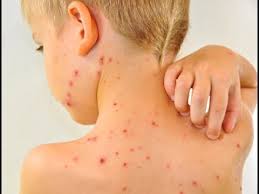 Chicken Pox Varicella Youtube