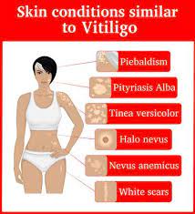 Oct 22, 2017 · pityriasis versicolor is a common condition, due to a yeast infection, that causes lighter or darker patches on the skin. Pityriasis Alba Ursachen Symptome Behandlung Medlexi De