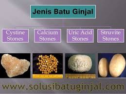 Apakah Anda Mengetahui Jenis Dan Bentuk Batu Ginjal Tahukah Anda Bahwa Penyakit Batu Ginjal Yang Dibiarkan Dapat Mengakibatkan Efek Buruk Herbal Tahu Bentuk