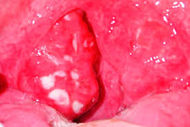 Check spelling or type a new query. Gatal Gatal Di Dalam Tekak Bagaimana Untuk Merawat Pada Waktu Malam Gatal Tekak Dari Bahagian Dalam Dan Mahu Batuk Apa Yang Perlu Dilakukan Dengan Anak Gatal Tekak Dan Batuk