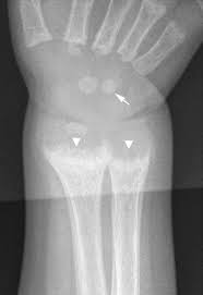 Metabolic Bone Disease And Other Alternative Reasons For Fractures Radiology Key