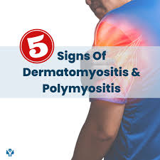 Image result for Polymyositis