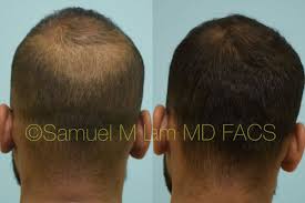In the original trials for propecia, the 1mg dosage was found to result in a significant net increase in hair count after 12 months. Dallas Finasteride And Minoxidil Before And After Photos Plano Plastic Surgery Photo Gallery Dr Samuel Lamfinasteride And Minoxidil Archives Lam Sam Hairtx Com
