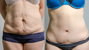 Apr 01, 2020 · as a standalone procedure, liposuction usually costs around $3,500. Tummy Tuck Surgery Abdominoplasty Packages In Thailand Malaysia And More