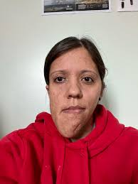 Living with neurofibromatosis type 1