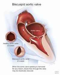 mayo clinic q and a mild to moderate aortic stenosis