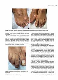 Image result for Onychotillomania feet