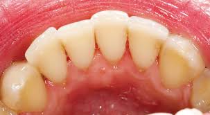 Some bacteria in plaque are harmless, but some are in most cases, your dentist or dental hygienist will be able to give your teeth a thorough clean and remove any hardened plaque (tartar). How Gum Disease Gets Started