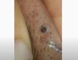 It may appear on the scalp of men with shaved heads. Causes Ingrown Hairs Head Archives New Pimple Popping Videos