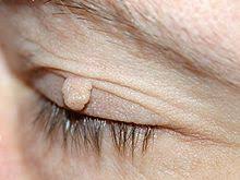 Fibrom Wikipedia