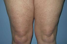 Image result for Urticaria pigmentosa children