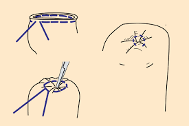 Image result for Purse String Suture
