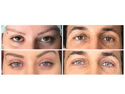 Wenn sie ihre augenfarbe ändern oder ihre natürliche augenfarbe stärker betonen wollen, dann generell muss man bei farbigen kontaktlinsen nichts anderes beachten, als bei regulären linsen. Augenfarbe Andern Mit Laser Oder Op Berlin De