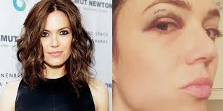What helps bruises fade quickly? How To Get Rid Of A Black Eye Self