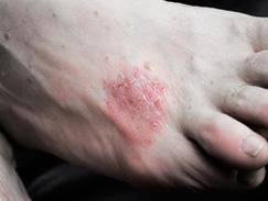 Le pansement peut être laissé en place plusieurs jours sans être changé. Psoriasis Des Traitements De Plus En Plus Efficaces