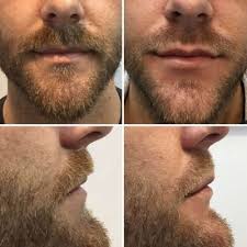 Maybe you would like to learn more about one of these? Thinning Or Uneven Lips The Cosmetic Clinic