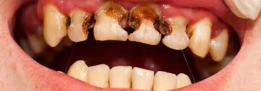 When you are finished, your teeth should feel smooth and clean, and you should be able to see the edges of your brackets clearly. What Happens If You Don T Brush Your Teeth Electric Teeth