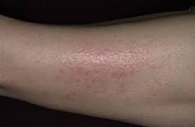O Chem Govorit Poyavlenie Zuda U Diabetika Vash Dermatolog Yandeks Dzen