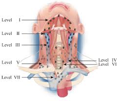 Swollen lymph nodes can be caused by a variety of problems like infections (mono, ear), cancers, hiv, and other symptoms like fever, night sweats, weight loss, toothache, or sore throat. The System Of Lymph Node Levels In The Neck As Described By Robbins Et Download Scientific Diagram