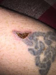 Book your tattoo removal appointment online and save. Tattoo Removal Laser Burn Will It Heal Photo