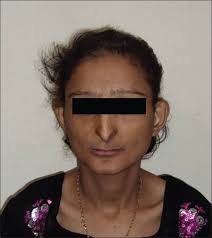 The syndrome is characterized by proportionate short stature, craniofacial dysostoses. Orodental Findings In Hallermann Streiff Syndrome Parikh S Gupta S Indian J Dent Res